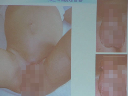 Đà nẵng phẫu thuật tái tạo bộ phận sinh dục cho 7 bệnh nhi - 1