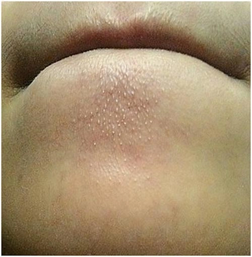 Tự làm nước thần tại nhà diệt sạch mụn li ti mụn ẩn - 2