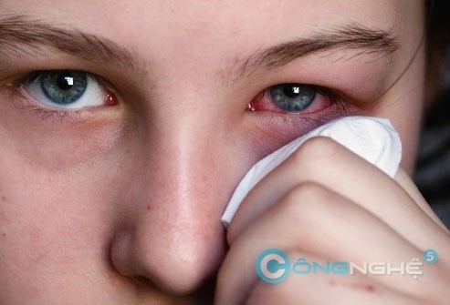 10 mẹo quan trọng cho người đau mắt đỏ