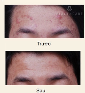 Bí quyết trị mụn siêu tốc đến từ hàn quốc