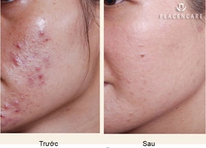 Bí quyết trị mụn siêu tốc đến từ hàn quốc