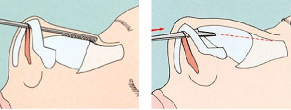 Những biến chứng khi nâng mũi bằng sụn tai