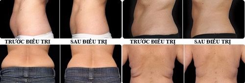 Tống khứ mỡ thừa với giai phap đông huy mơ
