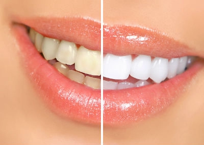 Tẩy trắng răng coi chừng thành hại răng