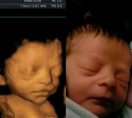 Hình ảnh của bé khi siêu âm và lúc đã chào đời