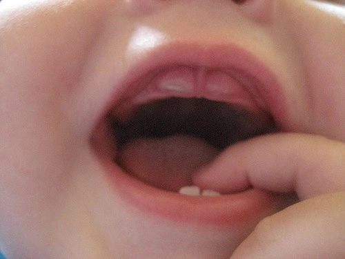 Làm gì khi bé chậm mọc răng