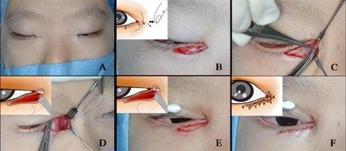 Cận cảnh phương pháp kích mắt to bằng phẫu thuật khóe 