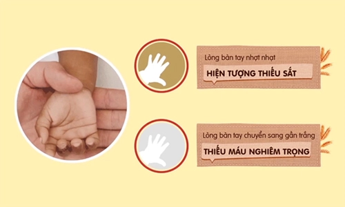 Dấu hiệu nhận biết trẻ thiếu sắt