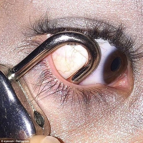 Xăm tròng mắt nhét kim băng móc khóa để làm đẹp cho mắt