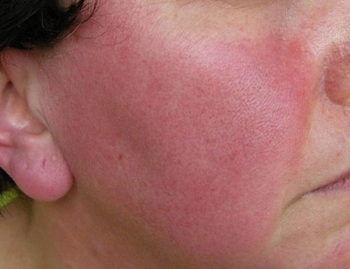 5 bệnh ngoài da thường gặp bị lầm tưởng là bệnh truyền nhiễm