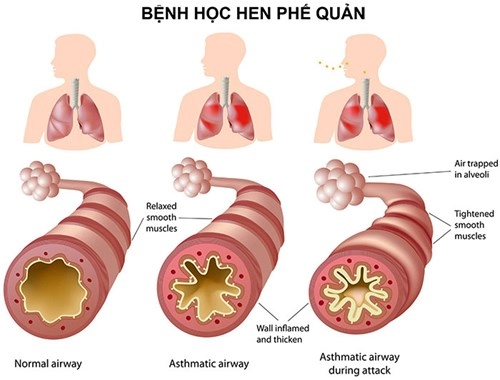 Bệnh hen phế quản 5 ngộ nhận nguy hiểm