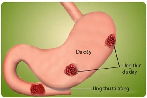 Các yếu tố nguy cơ và triệu chứng ban đầu của bệnh ung thư dạ dày