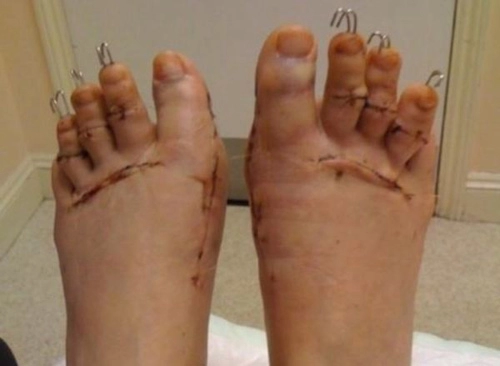 Mốt phẫu thuật chân để đi giày cao gót
