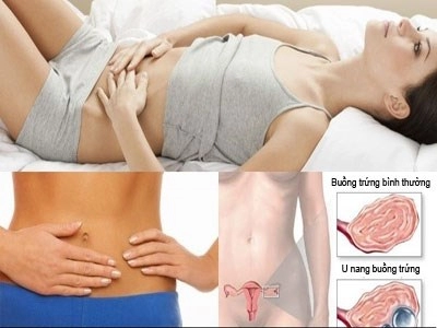 Những điều chị em chưa biết về hội chứng buồng trứng đa nang