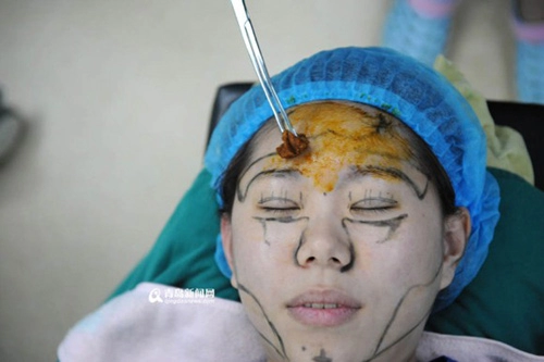 Phẫu thuật toàn bộ gương mặt để đỡ phải trang điểm