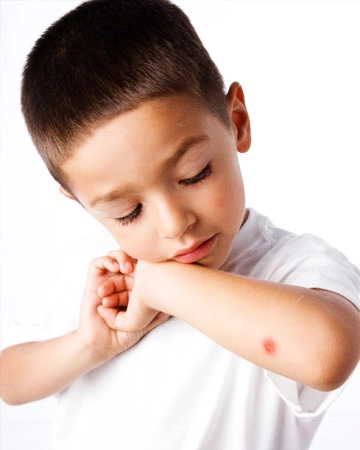 Trẻ bị muỗi đốt đã cósơn móng tay