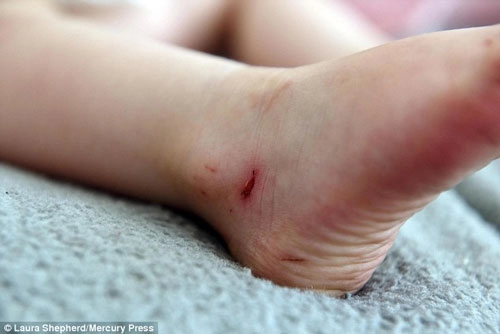 Bé 2 tuổi máu chảy đầm đìa vì đôi dép được bán phổ biến