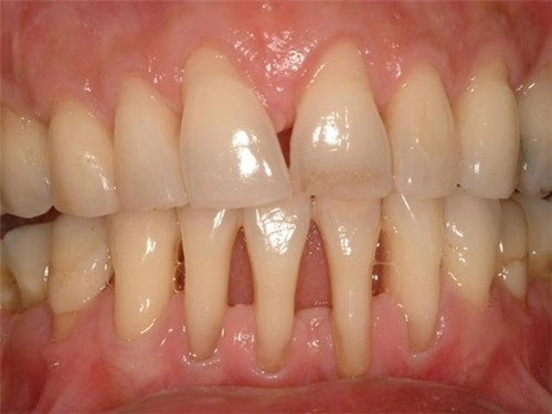Căn bệnh về răng miệng nguy hiểm mà bạn cần phải biết