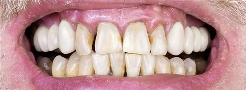 Căn bệnh về răng miệng nguy hiểm mà bạn cần phải biết