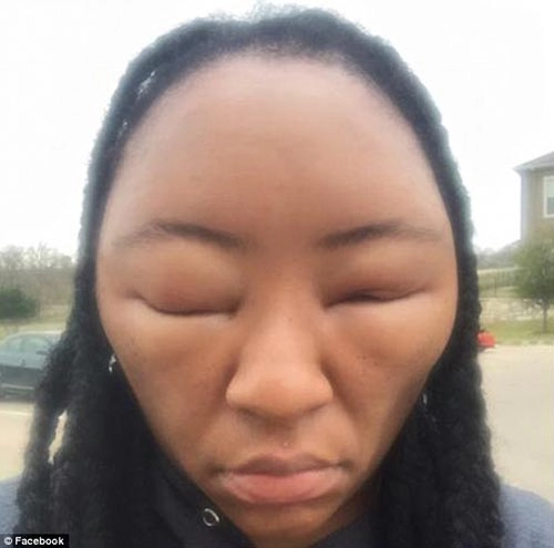 Cô gái biến dạng khuôn mặt vì dị ứng thuốc nhuộm tóc