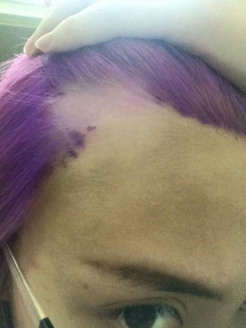 Cô gái việt bị phồng rộp tróc da đầu vì nhuộm tóc