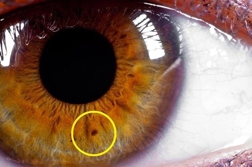 Đây là ý nghĩa của chấm đen trên mống mắt hãy kiểm tra ngay