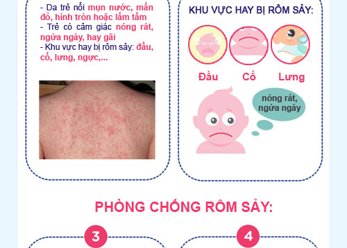 Infographics xử bay rôm sảy mùa hè cho bé