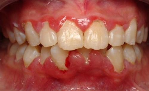 Người nào đánh răng không đủ 2 lầnngày sẽ khó thoát 10 bệnh này