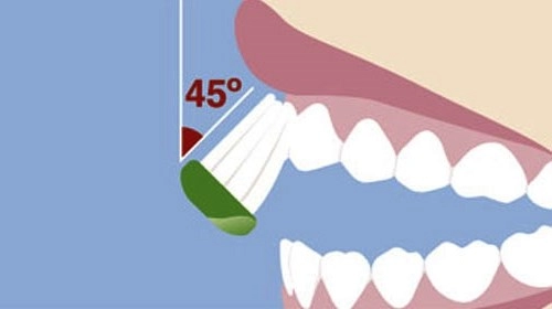 Phải làm sao khi đánh răng nhiều mà miệng vẫn hôi lợi vẫn viêm
