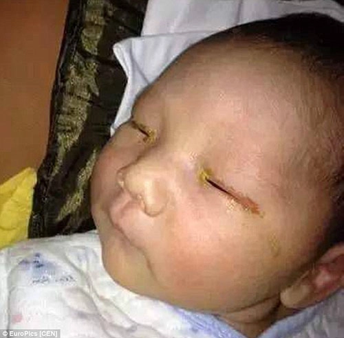 Trung quốc bé 3 tháng tuổi mù mắt vì đèn flash máy ảnh