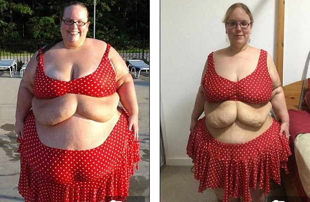 2 cô gái khốn khổ vì da thừa đáng sợ hậu giảm cân