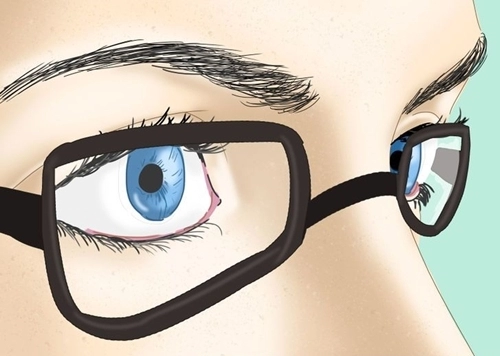 5 tình huống bạn tốt nhất đừng nên mổ cận thị lasik