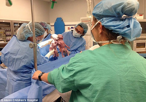 Cặp song sinh nắm tay nhau ra khỏi tử cung mẹ sau 2 năm chưa thể tách rời