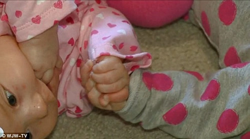 Cặp song sinh nắm tay nhau ra khỏi tử cung mẹ sau 2 năm chưa thể tách rời
