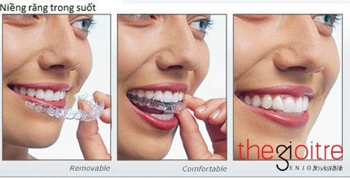 Công nghệ niềng răng trong suốt clevalign chính thức ra mắt ở việt nam