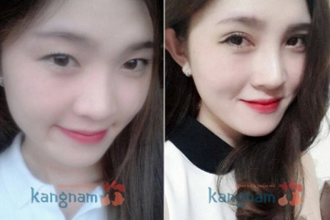 Quy trình biến hóa sắc đẹp korean beauty triangle ở kangnam