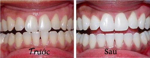 1 nhúm muối và 2 cách làm răng trắng bóng không ê buốt