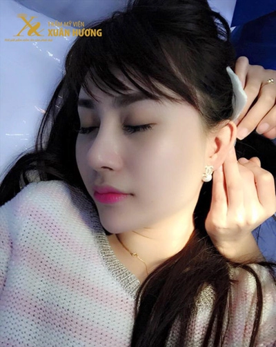 9x hà thành sở hữu dáng mũi đẹp như mơ sau ca phẫu thuật