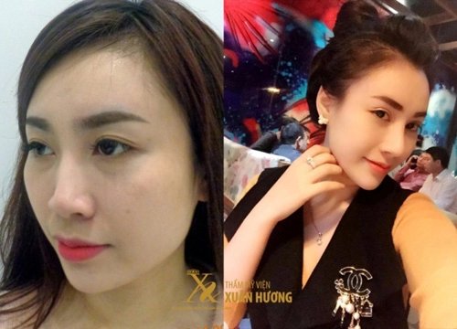 9x hà thành sở hữu dáng mũi đẹp như mơ sau ca phẫu thuật