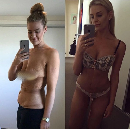 Cô gái gây choáng váng khi giảm được 85 kg và sexy bất ngờ