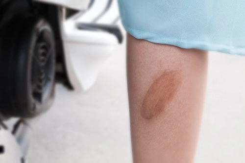 Khi bị bỏng bô xe máy đã có cách để tránh sẹo thâm xấu xí