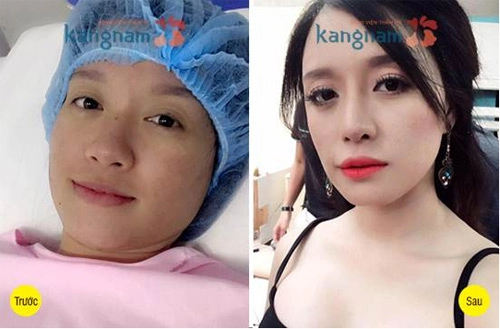 Mũi đẹp tỷ lệ vàng với công nghệ sline 3d được ưa chuộng