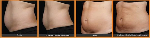 Tiết kiệm đến 65 trải nghiệm giảm mỡ giảm béo với sculpsure