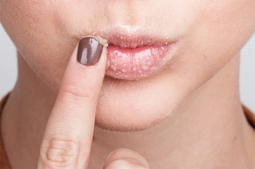 Trị thâm sạm nẻ môi do hanh khô chỉ trong một nốt nhạc với cách này
