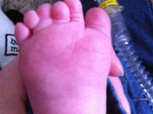 Bệnh hiếm gặp bé trai có 12 ngón chân 12 ngón tay
