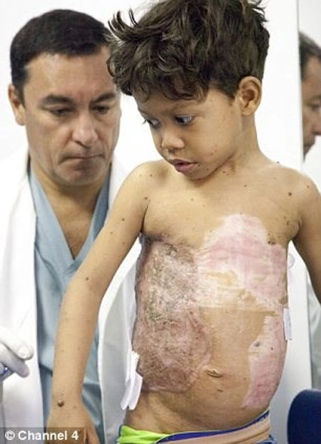 Cậu bé khổ sở vì khối u hình mai rùa trên lưng
