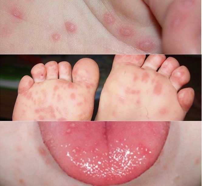 Chủng virus gây đại dịch tay chân miệng năm 2011 đã trở lại
