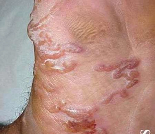 Kinh hãi bệnh nhân bị giun bò lúc nhúc dưới da