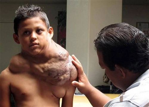Loại bỏ khối u khổng lồ trên vai cậu bé 11 tuổi