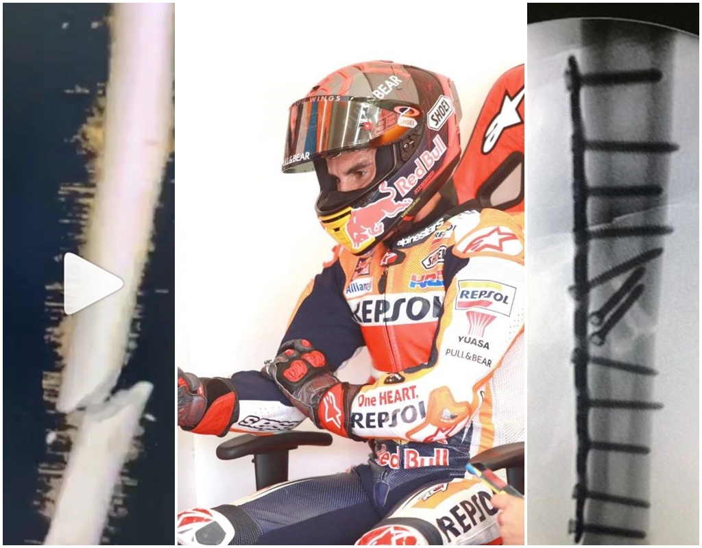 Marc marquez tiết lộ tình hình cánh tay phải trước và sau khi chụp x-quang